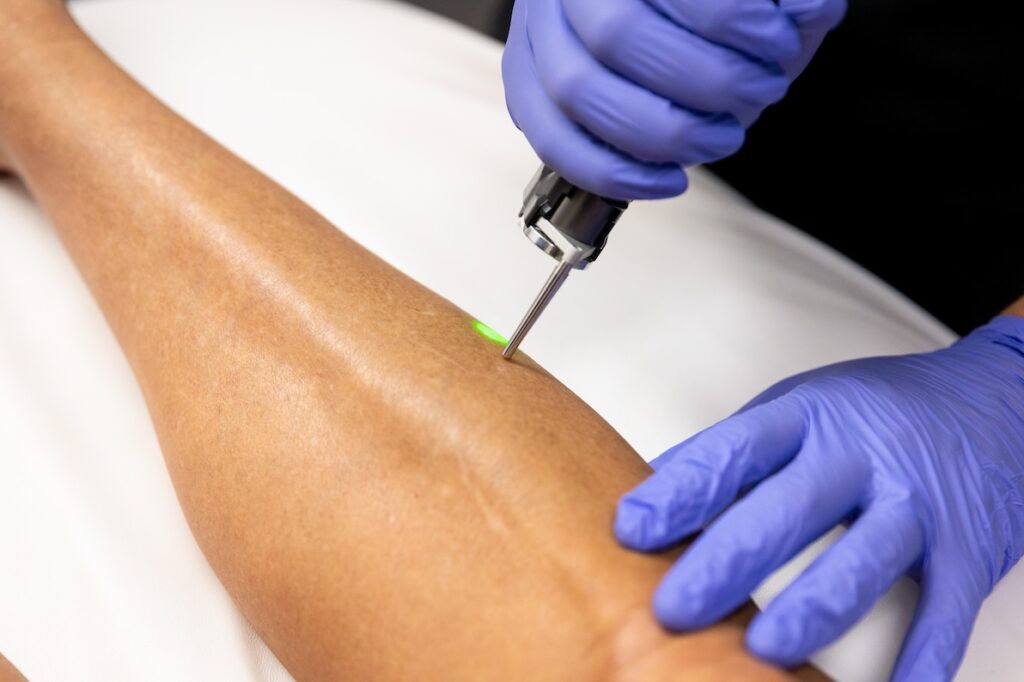 A provider uses laser and light treatments on a patient's leg to reduce unwanted hair.